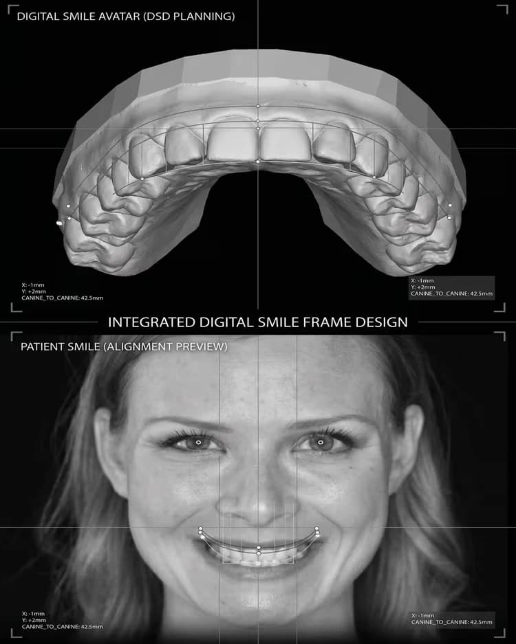 Digital Smile Design planning software: a 3D scan of an upper arch above an alignment preview mapped over the software maker's demonstration smile