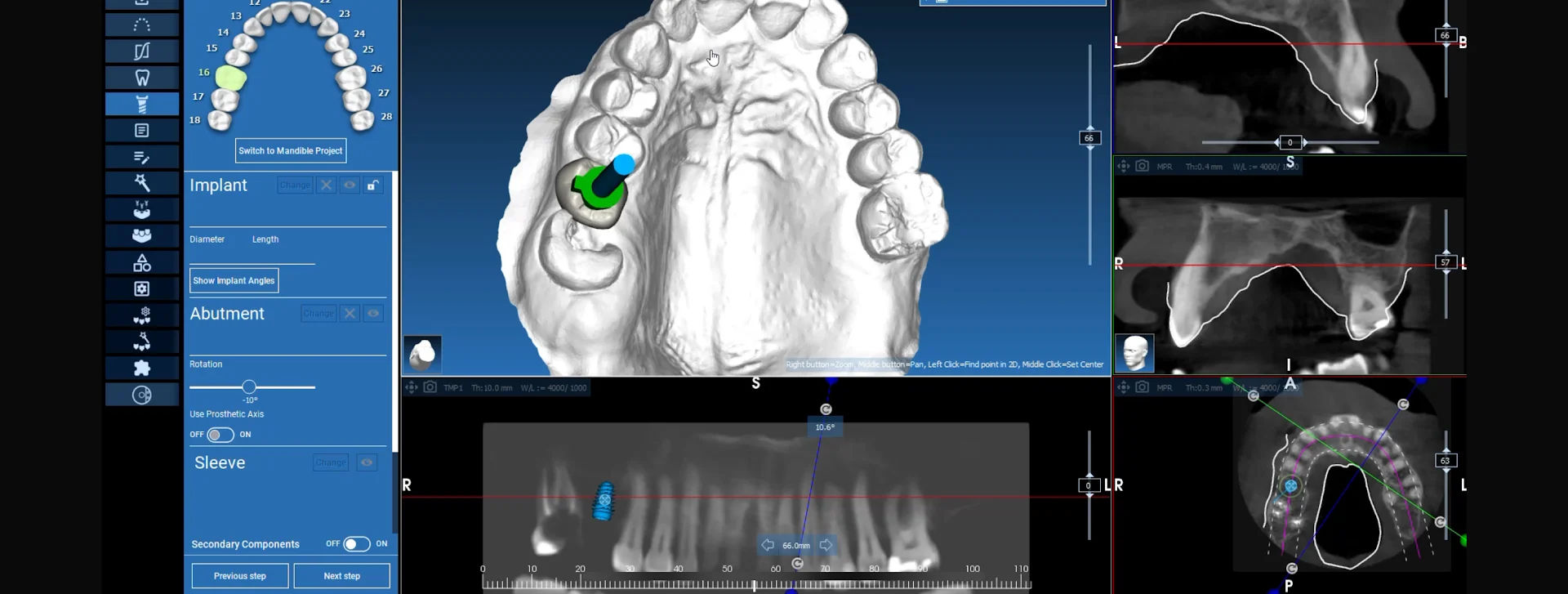 Single & Multiple Dental Implants