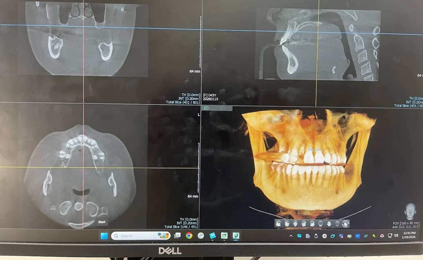 Implant-Supported Dentures in Front Royal, VA