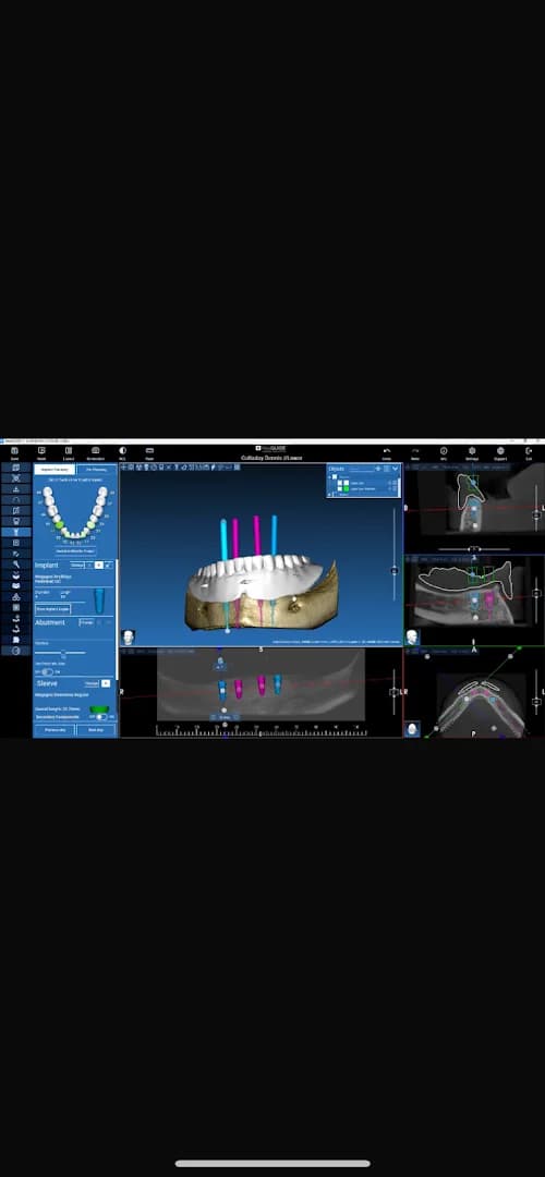 Digital Implant Planning & Guided Surgery